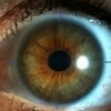 Cornea